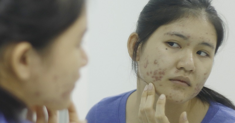 Có nên nặn mụn bọc không khi nào nặn mụn bọc được