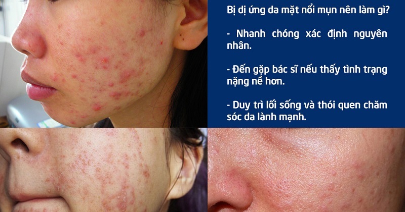 Da mặt bị dị ứng nổi mụn phải làm sao - Cách trị mụn dị ứng da mặt hiệu quả