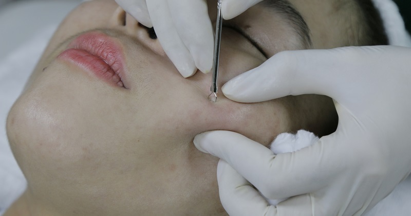 Đi nặn mụn ở spa có bị lây bệnh không?