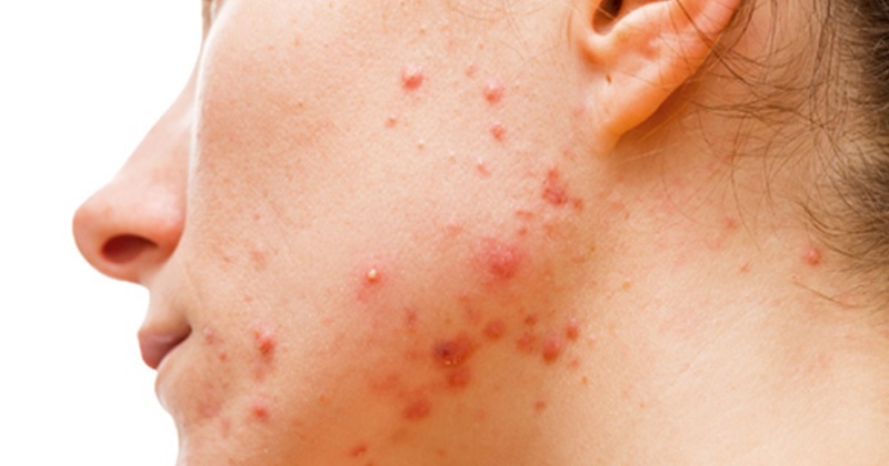 Dị ứng mỹ phẩm có tự hết không kéo dài bao lâu thì khỏi