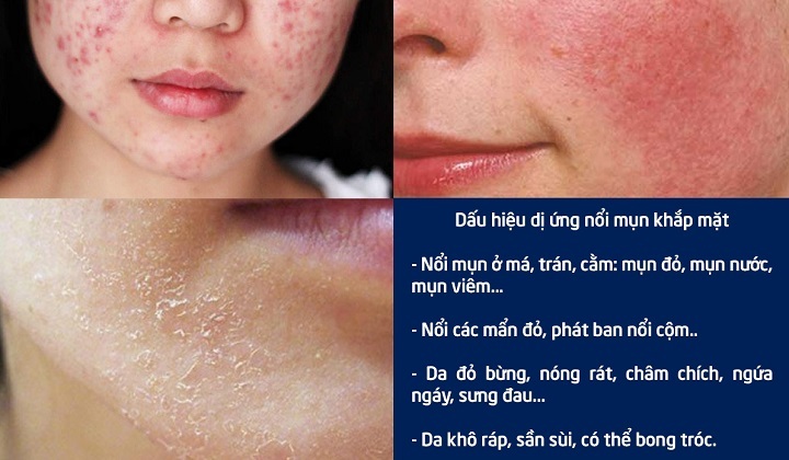 Dị ứng nổi mụn khắp mặt: Nguyên nhân và dấu hiệu nhận biết