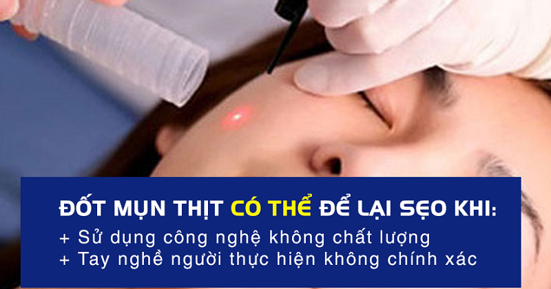 Đốt mụn thịt bị thâm sẹo hay không bao lâu thì hết thâm