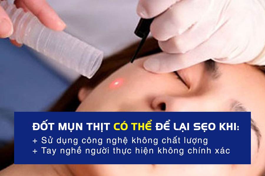 Đốt mụn thịt có để lại sẹo không?