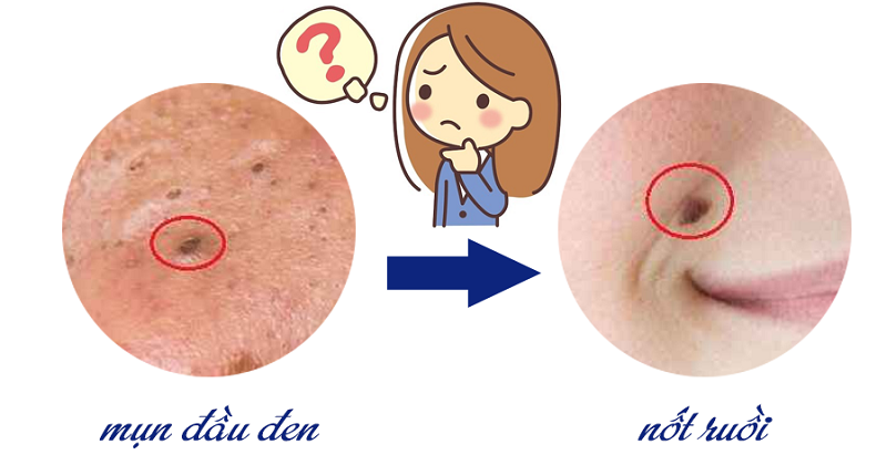 Giải đáp mụn đầu đen không nặn thành nốt ruồi không?