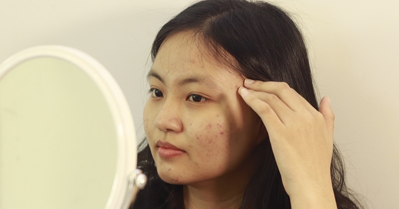 Hết tuổi dậy thì có hết mụn không mụn tuổi dậy thì kéo dài bao lâu