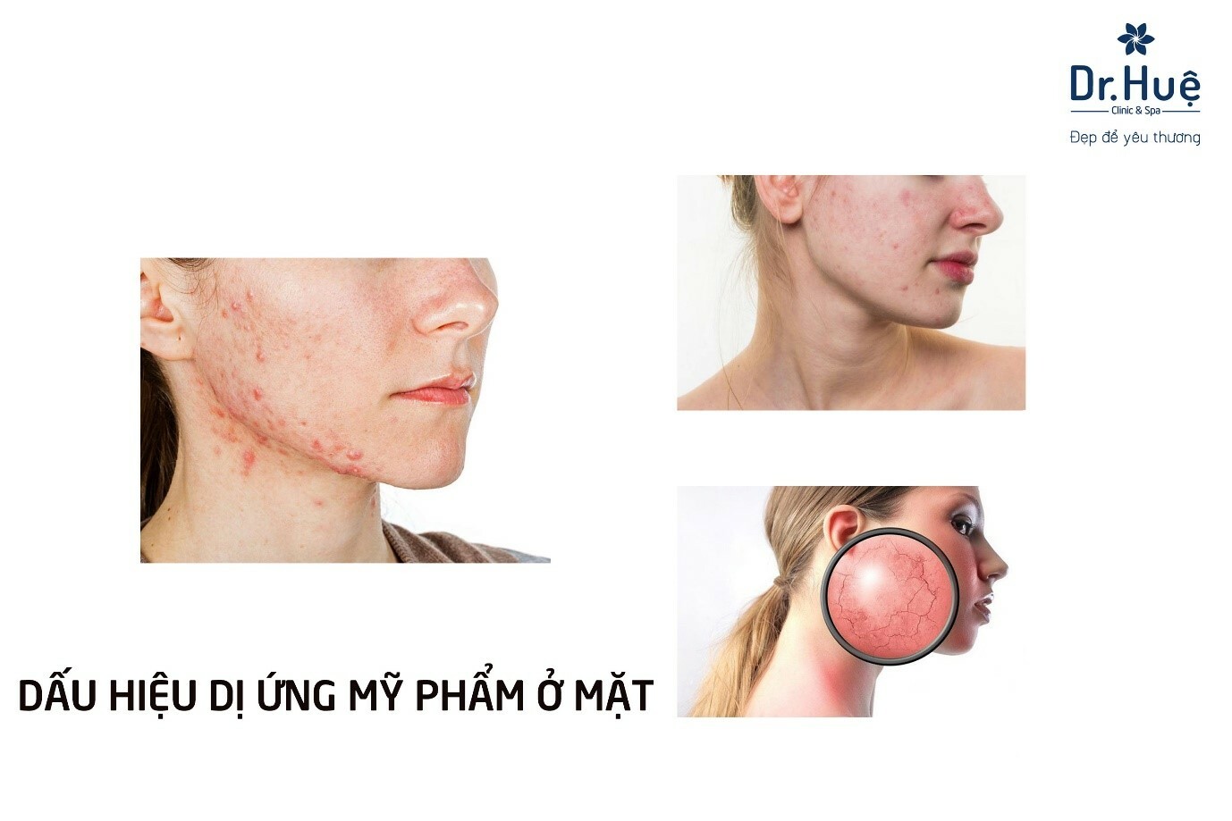 LÀM ĐẸP THÔNG MINH NÓI KHÔNG VỚI DỊ ỨNG MỸ PHẨM