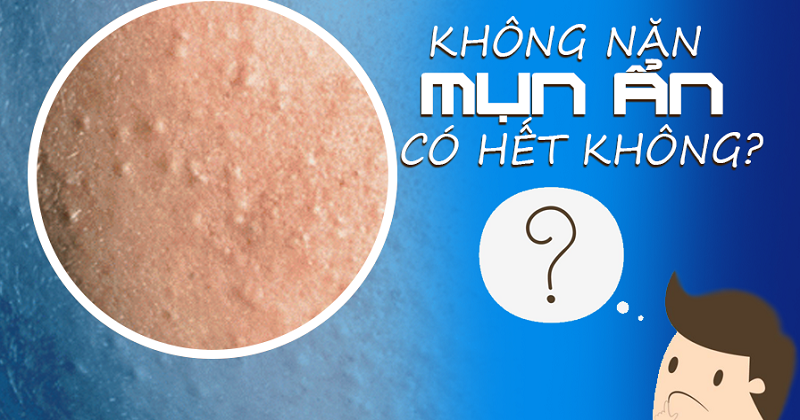 Mụn ẩn để tự nhiên không nặn mụn ẩn có hết không
