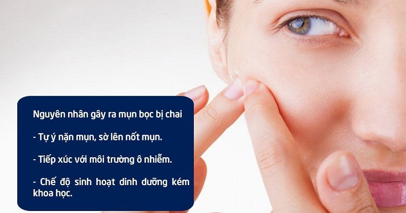 Mụn bọc bị chai là gì cách trị mụn bọc bị chai tại nhà hiệu quả