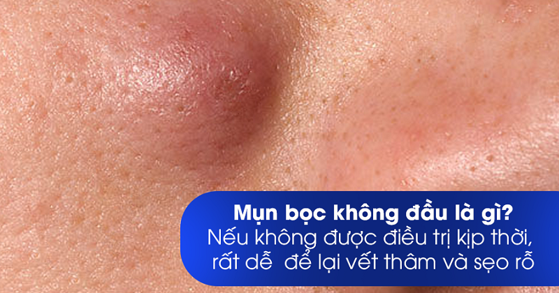 Mụn bọc sưng không đầu là gì nguy hiểm không và cách trị hiệu quả