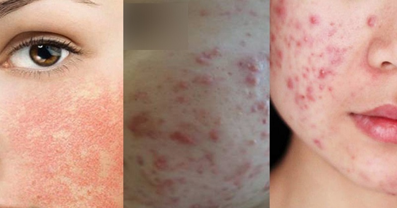 Mụn dị ứng mỹ phẩm là gì và cách trị dị ứng mỹ phẩm nhanh nhất
