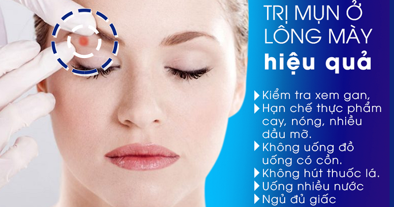 Mụn mọc ở lông mày có bị sao không - Cách trị hiệu quả