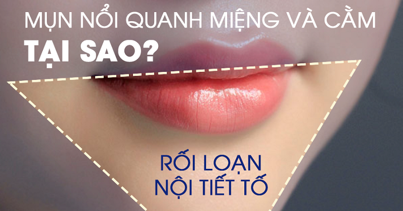 Mụn nổi quanh miệng mọc nhiều ở cằm do đâu và cách trị