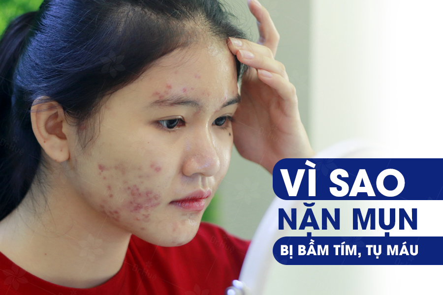 Vì sao nặn mụn bị bầm tím, tụ máu?