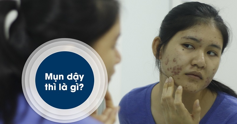 Nguyên nhân nổi mụn và các loại mụn thường gặp ở tuổi dậy thì