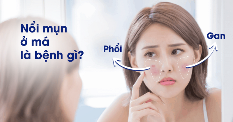 Nổi mụn ở má là bệnh gì - vì sao bị mụn ở má và cách trị