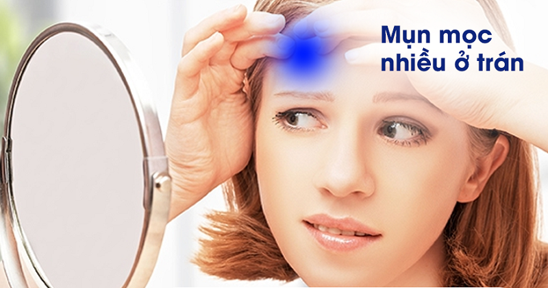 Nổi mụn trên trán là bị gì - Nguyên nhân mọc mụn ở trán và cách trị