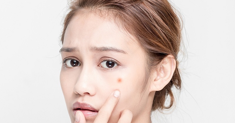Tổng hợp cách trị mụn trứng cá tuổi dậy thì hiệu quả nhất hiện nay