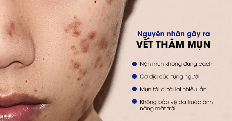 Vết thâm mụn có tự hết không sau bao lâu thì hết?